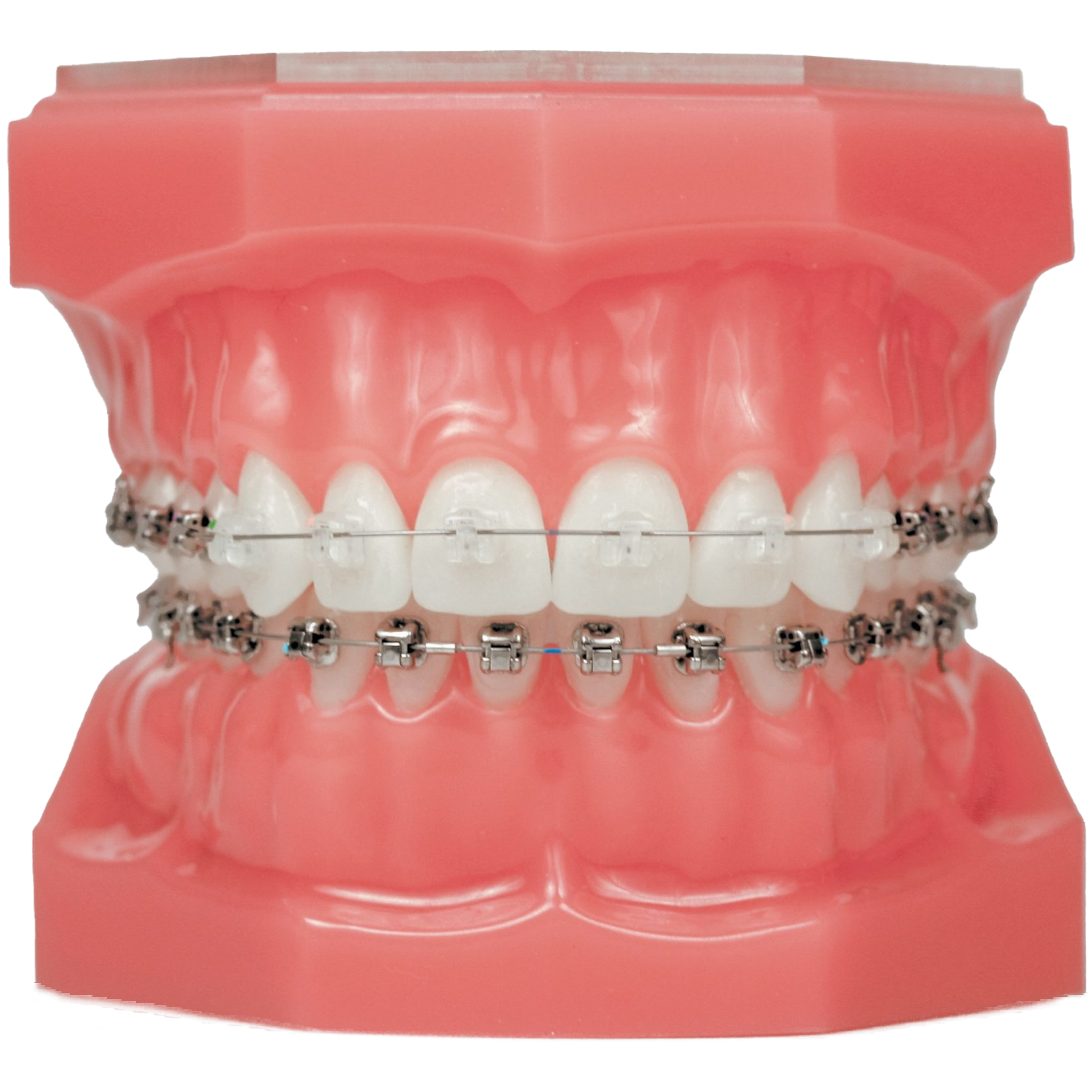 clear braces on plastic model